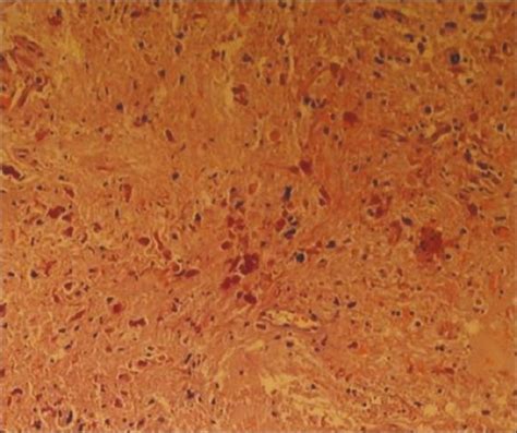 The histopathology confirming the diagnosis of pilocytic astrocytoma ...