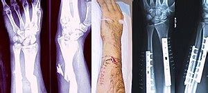 Bone fracture - Wikipedia