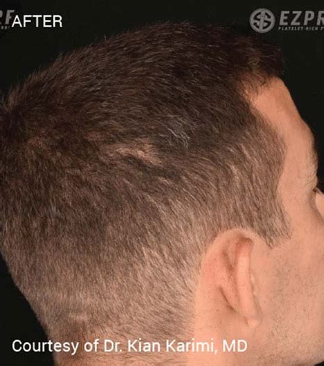 Prf Hair Restoration In Livermore Ca Sculpt Md