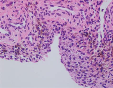 Hematoxylin And Eosin Staining Showing Fibroblasts And Giant Cells With Download Scientific