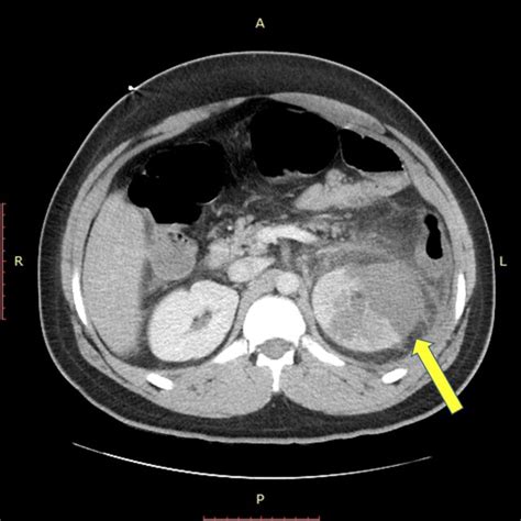 Abdominal Computed Tomography Scan With Contrast Showing Left Renal Download Scientific Diagram