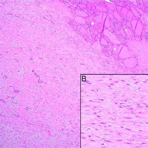 A Bland Spindle Cell Proliferation Arranged In Ill Defined Fascicles