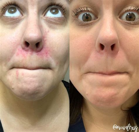 Perioral Dermatitis Update January Artofit