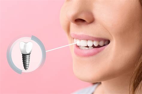 Dental Implants Why Your Jawbone Needs Them