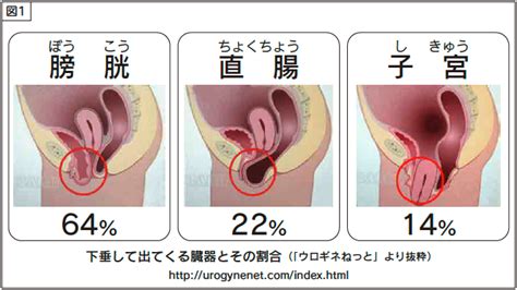 骨盤臓器脱は手術治療がオススメです｜健康情報利根中央病院