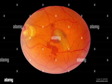 Desprendimiento de retina oftalmoscopio imagen El área de la retina