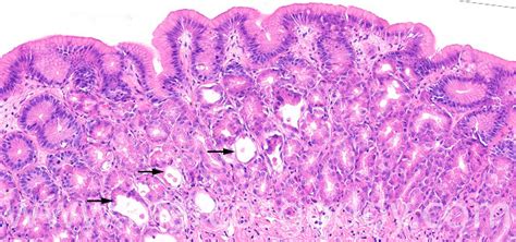 Gastric Gland Necrosis In Atlantic Salmon Salmo Salar Histopathology