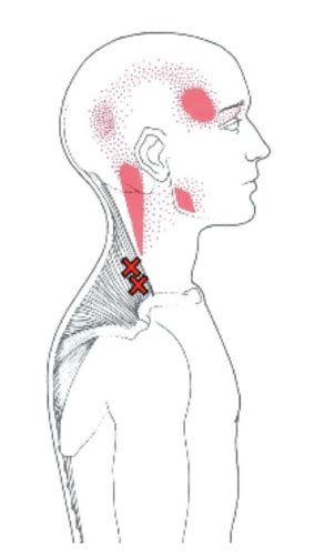 Trigger Points Flashcards Quizlet