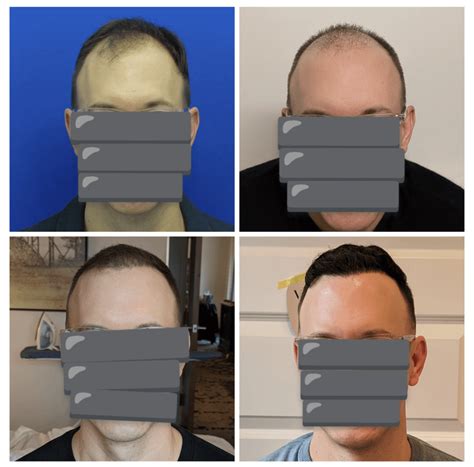 7 Months Progress 4500 Fue 42m Rhairtransplants