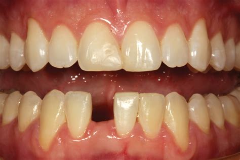 A Conservative Post Orthodontic Solution For Restoring Missing Lateral