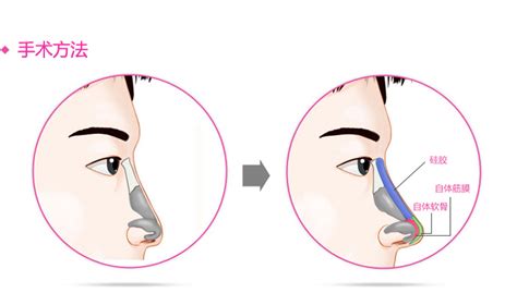 韩国原辰假体隆鼻常用的材料有哪些韩国原辰整形医院韩国整形韩国整容抗衰老微整形韩式整容赴韩整形韩国最好的整形医院