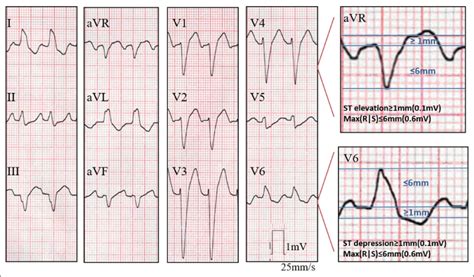 Ecg From A Patient With Acute Myocardial Infarction And Culprit Lesion Download Scientific