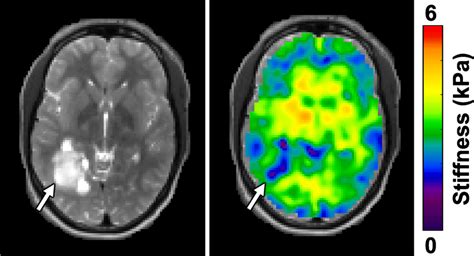 Axial Anatomical Image And Mr Elastography Stiffness Map From A