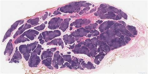 Thymic hyperplasia | Atlas of Pathology