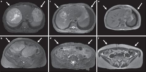 Figure 2 From Disseminated Peritoneal Leiomyomatosis Responds To