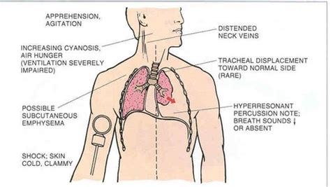 Tension Pneumothorax Tracheal Deviation