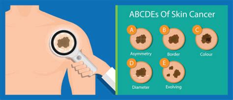 Early Detection Is Key To Effectively Treating Skin Cancers