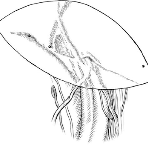 Port Placement For Tapp And Tep Hernia Repair Download Scientific Diagram