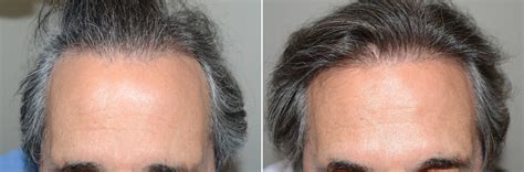 Hair Transplants For Men Photos Miami Fl Patient123951