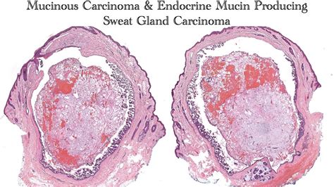 Mucinous Carcinoma Endocrine Mucin Producing Sweat Gland Carcinoma