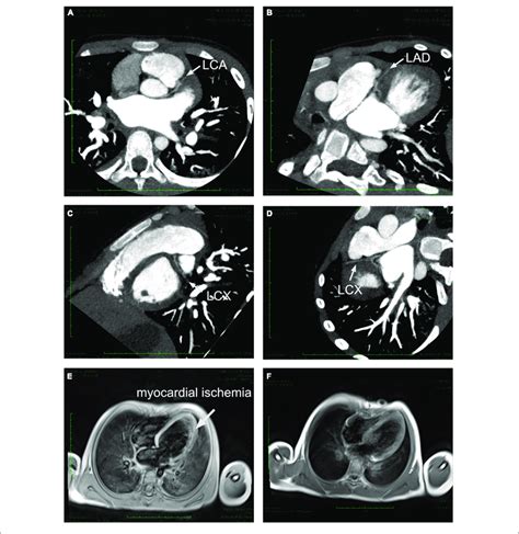 Cardiac CTA And MRI Imaging A Left Coronary Artery Originated From