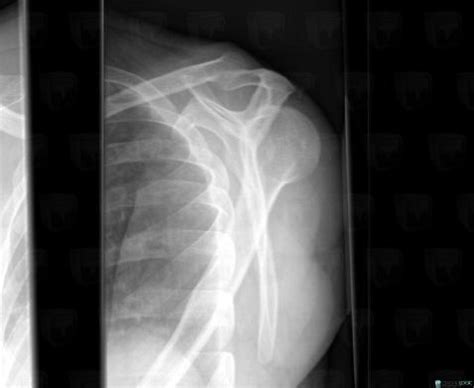 Radiology case : Dislocation (X rays ,CT) - Diagnologic