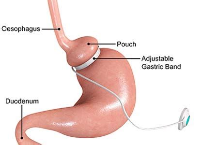 Gastric Banding Surgery India: Causes, Procedure, Hospitals