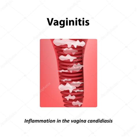 Vaginitis Entzündungen In Der Scheide Candidiasis Drosseln