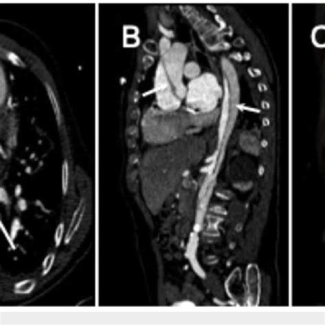 Type A Aortic Dissection A Axial Contrast Enhanced Ct Image