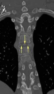 RiT radiology: "Vertebra Plana-Like" Lesion