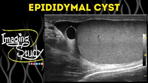 Epididymal Cyst Diagram