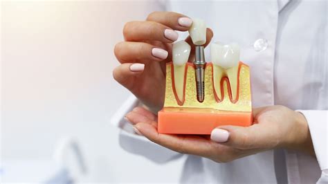 How to Care For Dental Implants: 7 Tips for Looking After Implants