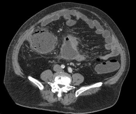 Appendicular Abscess Radiopaedia Appendicular Abscess Unprocessed Appendicitis May In Addition