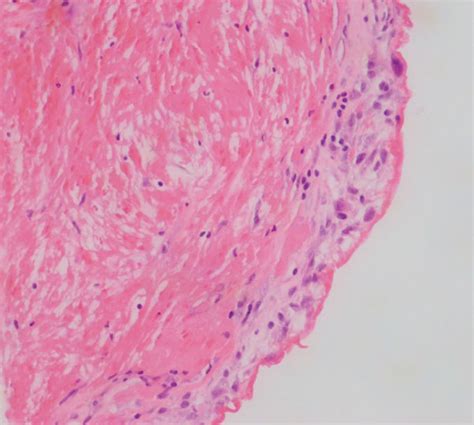 H&E stain of biopsy of pericardial tissue showing thickened pericardial ...