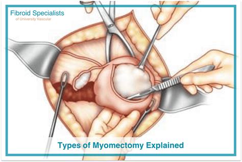 Types Of Myomectomy Hysteroscopic Laparoscopic Abdominal Fibroid