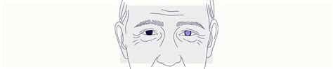 Cataracts: Symptoms, Causes, Diagnosis, Treatment