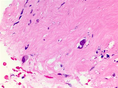 Pathology Outlines Acanthamoeba Keratitis