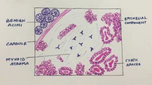 Pleomorphic adenoma – Histopathology.guru