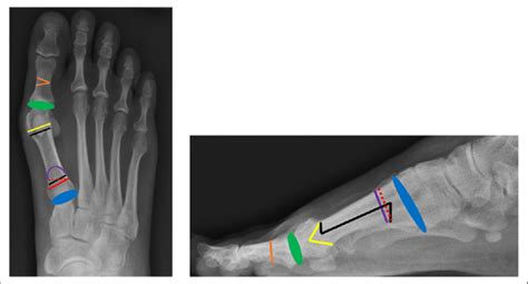 Anteroposterior Ap And Lateral View Demonstrating Various Surgical