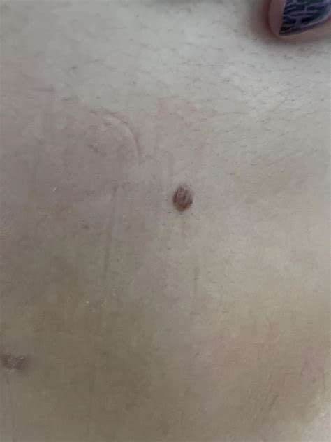 is this a third nipple under my right breast? : r/ThirdNipple