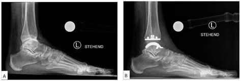 JCM Free Full Text Mobile Anatomical Total Ankle Arthroplasty