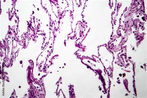 Emphysema Histology Labeled