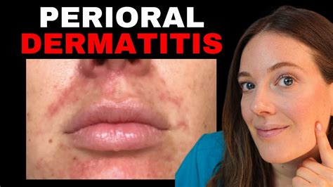 How To Treat Red Bumps Around The Mouth Perioral Dermatitis YouTube