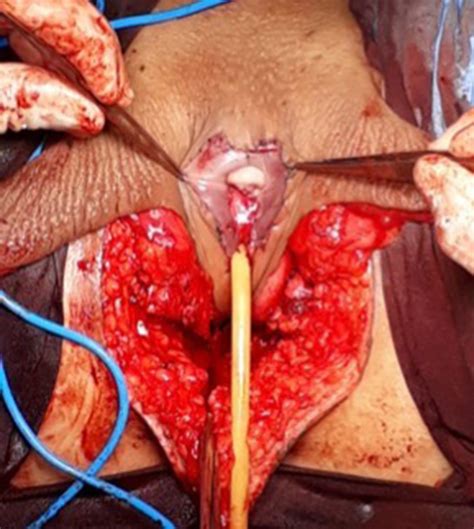 Frontiers | Male-to-Female Gender-Affirming Surgery: 20-Year Review of