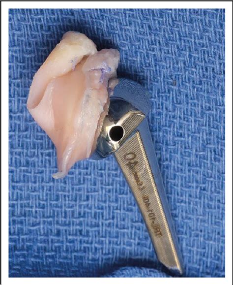 Figure 1 from Ulnar head replacement and sigmoid notch resurfacing arthroplasty with minimum 12 ...