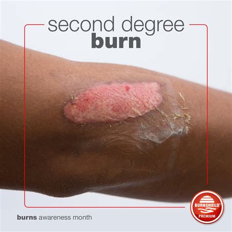 Second Degree Burn