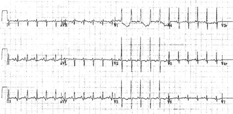 Common Paediatric Arrhythmias • Litfl • Ecg Library Diagnosis