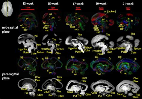 Sagittal Brain Hippocampus