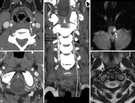 Vertebral Artery Dissection Mri