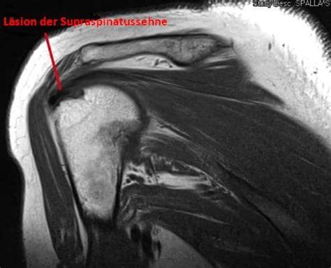 Läsion der Supraspinatussehne der Schulter Symptome Reabilitation und